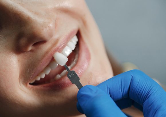 crowns-bridges Crowns & Bridges