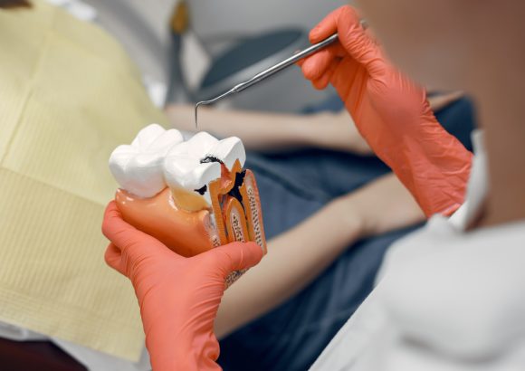 Wisdom Tooth Extraction